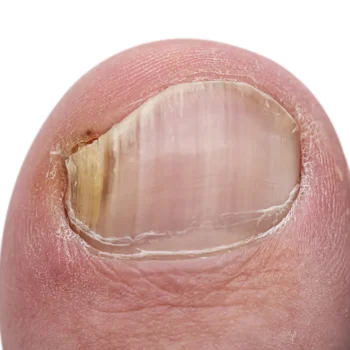 Toenail & Fingernail Disorders